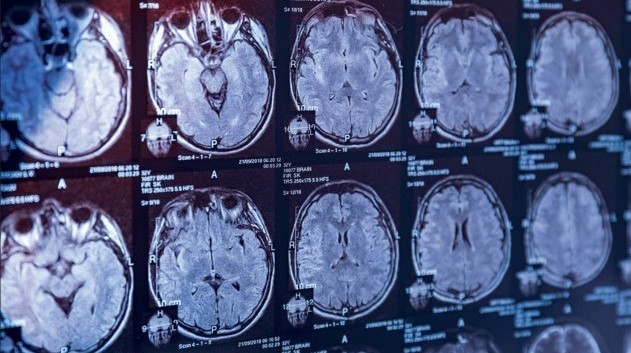 [The Lancet] Report finds no common cause for mystery brain disease.